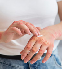 Skin Diseases